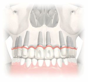 Implants dentaires