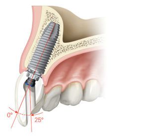 Implants dentaires