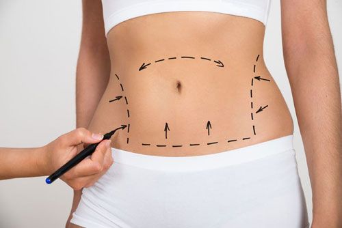 Tummy Tuck - LA Vascular