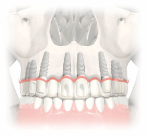 Implants dentaires