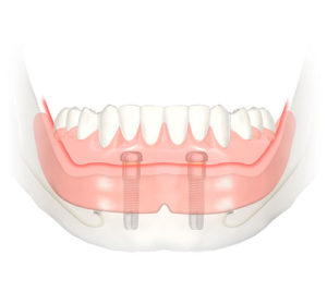 Implants dentaires