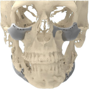Chirurgie orthognatique
